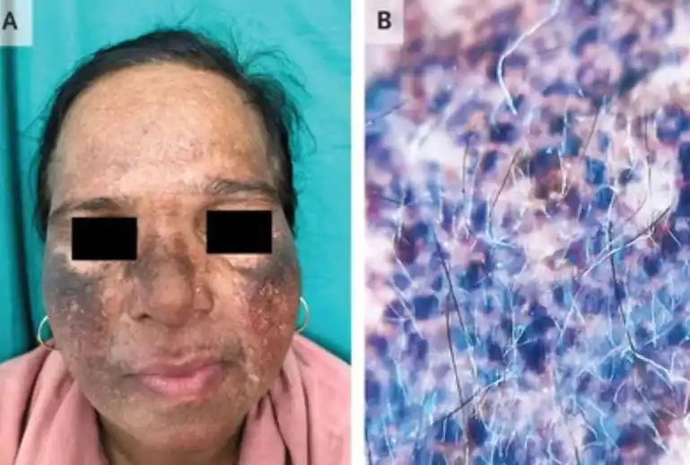 Skin lightning cream hazard: Woman’s skin turns blue-brown after using fairness product [See pictures]