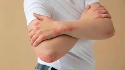 Tinea Can Be Really Harmful For Your Skin? Know About This Fungal Infection