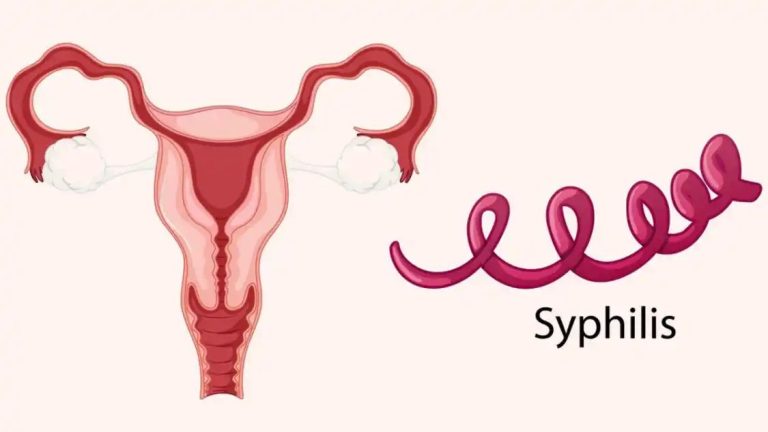 Syphilis: Expert Shares Treatment Options and Vital Preventive Measures