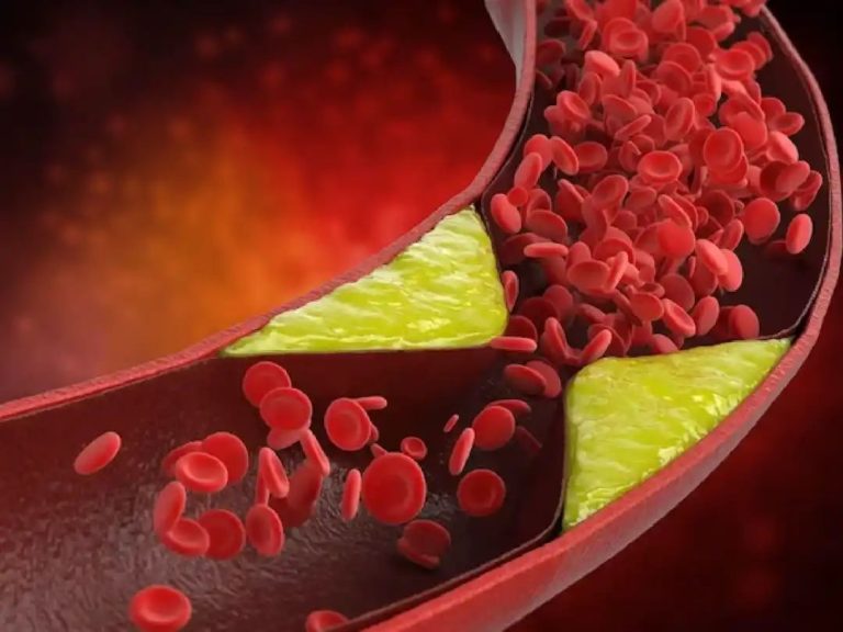 High cholesterol: Top 5 Ayurvedic herbs to reduce risk of heart attack