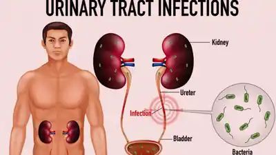 Blood In Urine To Frequent Urination, How Does UTI Affect Men?