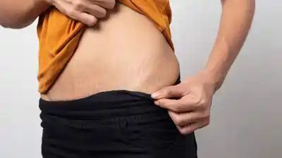 Stretch Marks: Expert-Recommended Tips To Get Rid Of It