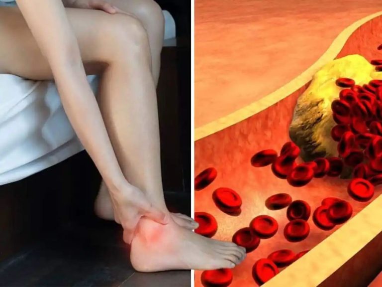 High Cholesterol Symptoms In 30s: Unusual 7 Signs Of High Bad LDL Cholesterol Levels On Legs And Feet