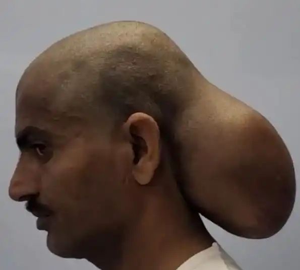 Indian man lives with 2 heads for years, gets it removed after 15 years – know what caused it