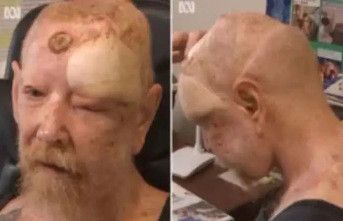 Man gets 200 skin cancers scraped off because of never using a sunscreen; see disturbing pictures