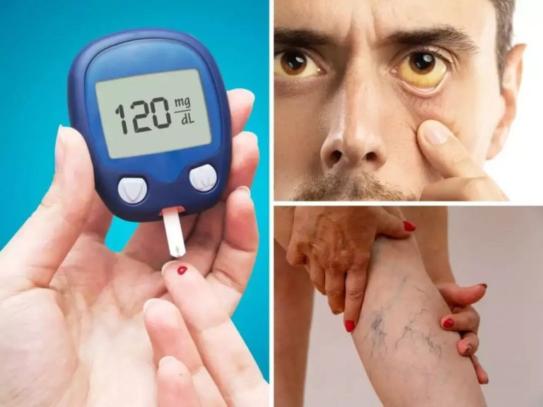 Diabetes Symptoms In Men: Top 7 Unusual Signs of Insulin Deficiency Causing High Blood Sugar In Legs and Feet