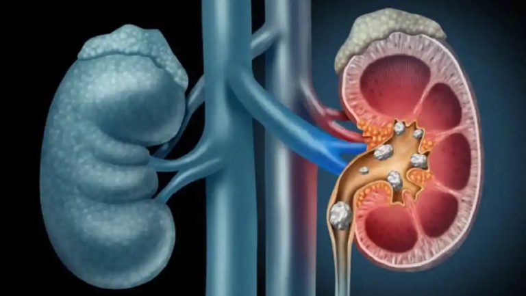 Kidney stones: Expert lists 3 major reasons behind the development