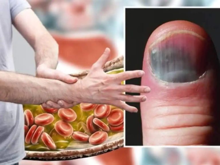 Vitamin B12 Deficiency Symptoms In Men At Night: Top 7 Warning Signs of Vitamin B12 Deficiency In Hands And Limbs