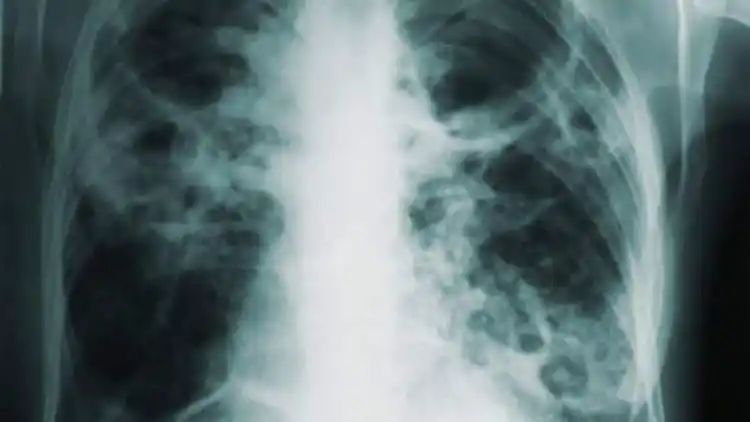 AI can help predict whether a patient will respond to specific tuberculosis treatments, paving way for personalised care