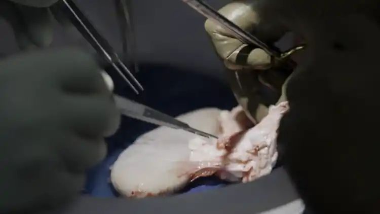 Surgical Milestone: World’s first transplant of genetically-edited pig kidney to a live patient