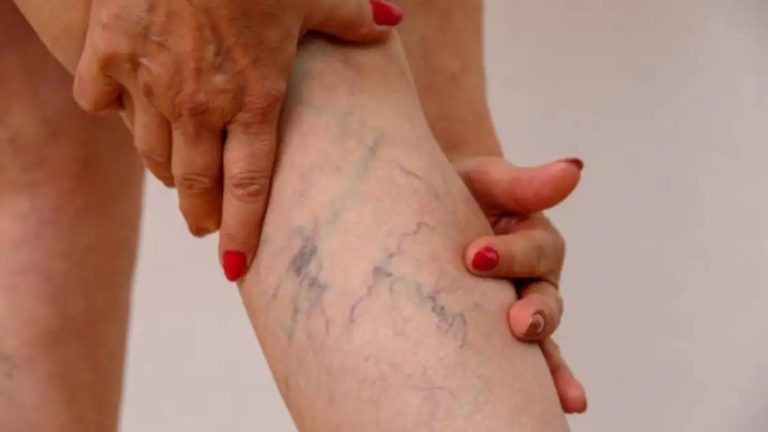 Varicose veins prevalent in 40 to 50 pct Indians: Don’t ignore this condition