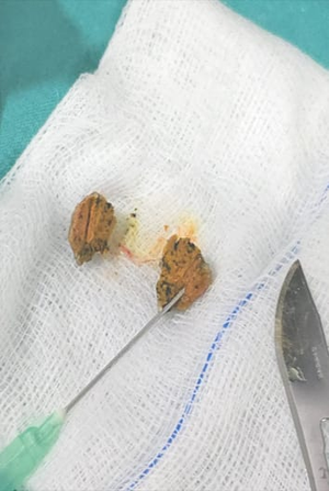 Pune doctors remove turmeric pieces that formed layers in elderly man’s lungs