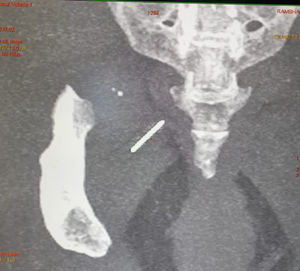 Doctors extract needle embedded deep for 3 years in hip muscle of woman