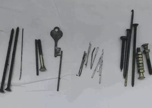 Nails, needles, nuts and bolts removed from man's stomach in Jaipur