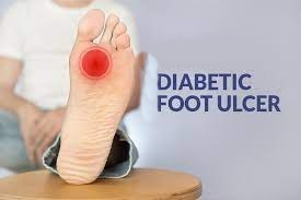 Monsoon likely to trigger foot ulcers in diabetic patients: Experts