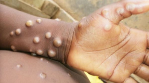 Mpox impacting a broader demographic, warns Lancet report