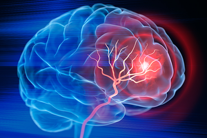 People with aneurysm at high mental health condition risk: Study