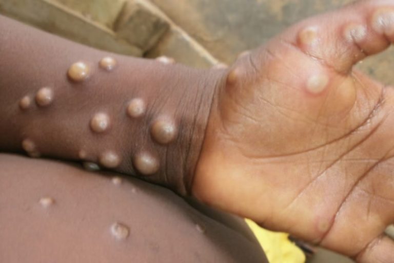 First Case Of Monkeypox Confirmed In India: Ministry Of Health