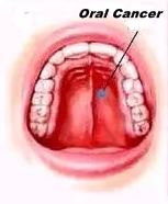 Smokeless tobacco, betel nut drive oral cancer cases in India, highest in South Asia: Lancet